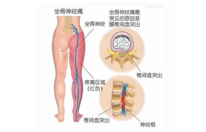 腰椎间盘突出患者为什么会腿疼？